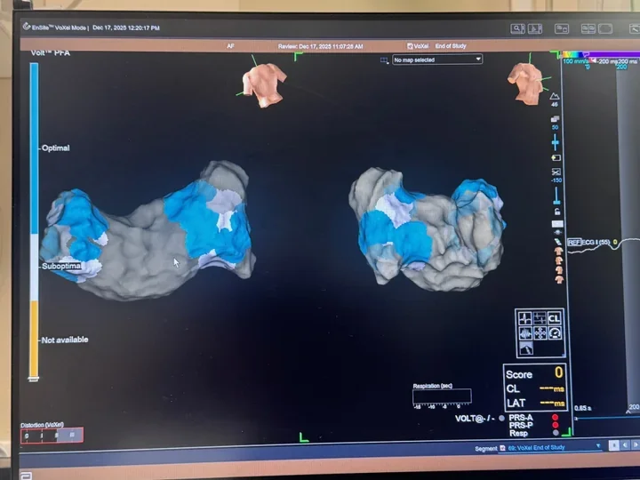 Nowe metody leczenia arytmii i 11,6 mln zł na cyfryzację w szpitalu
